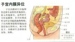 子宫内膜异位症可以做试管怀孕吗?