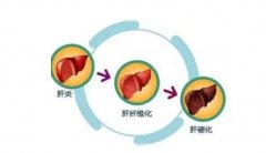 怎么判断急慢性肝炎？这些症状提前了解