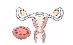多囊卵巢患者做人工授精有什么好处？
