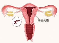 为什么有的人没有子宫内膜？没有内膜有影响吗？