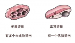 多囊卵巢患者能怀孕吗？试管婴儿技术效果好