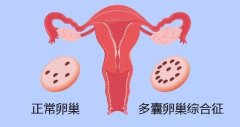 得了多囊卵巢还能怀孕吗？几个真相看完不焦虑