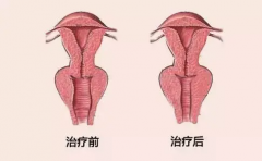 顺产后是否需要缩阴？顺产后恢复紧致的小秘诀