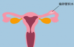 输卵管积水造成不孕，想要怀孕可以用这些方法