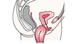 子宫颈脱出有哪些症状，预防子宫颈脱出要做好防护