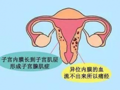 子宫腺肌症能做试管婴儿吗？受孕成功率有多高？