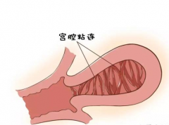 宫腔粘连手术后多久能做试管婴儿？一般需2-3个月时间