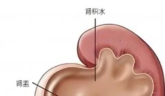 新生儿肾积水是怎么回事?新生儿左肾积水治疗时间是什么时候?