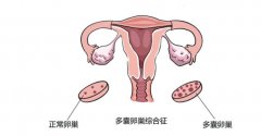 多囊卵巢患者容易忽视的饮食习惯，注意后孕气会越来越好！