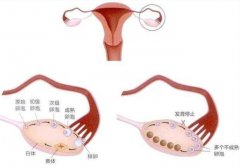 如何进行多囊卵巢的准确诊断？这些黄金诊断标准值得收藏