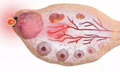 到底多少个卵泡是多囊？这些因素不可忽视！