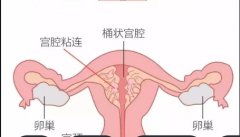 宫腔粘连是怎么回事？治疗宫腔粘连的手术方式怎么样的？