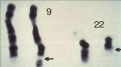 一文了解9号染色体多态性改变，三代试管技术对未来的意义