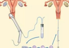 一文解析精子dna碎片率50%三代试管技术优势