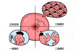 宫颈糜烂状态下试管婴儿成功率怎么样？了解影响成功率的关键因素