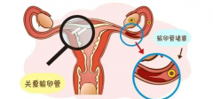 输卵管堵塞，还能做试管吗?别慌，答案在这里!