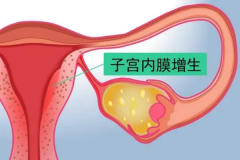 科普子宫内膜增生，可能影响试管婴儿成功率