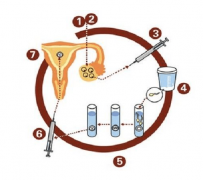 GnRH降调针在试管婴儿中的应用：为何需每日固定时间注射？剂量详解！