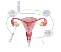 试管婴儿选拮抗剂方案，要啥条件？促排时，这四点你得牢记！