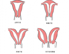 双子宫试管放双胎，你真的想好了吗?