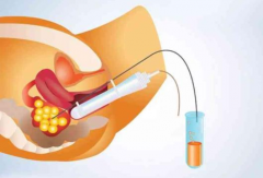 试管婴儿取卵5大注意事项，每一点都很关键！