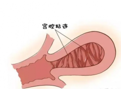 宫腔粘连能做试管婴儿吗？手术后恢复情况很关键！