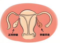 45岁女性患有卵巢早衰能尝试做试管吗？提高成功率的几大方式！