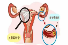 双侧输卵管堵塞不用急，可以尝试试管婴儿生育！