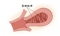 宫腔粘连影响试管婴儿吗？答案可能跟你想象的不一样！