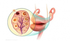 高龄女性做试管选哪种方案好？微刺激方案更适合你