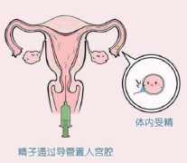 人工授精可以生男孩，也需注意还有这些风险在