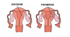 子宫内膜异位症不影响试管移植，但是会降低怀孕成功率