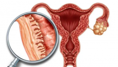 子宫内膜增厚：试管成功路上的隐形障碍，刮宫术或成破局关键