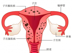 子宫腺肌症也能成功试管？这些腺肌症试管成功经验你必须掌握！