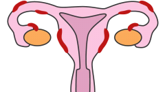 子宫内膜异位症可以做试管婴儿，照样能怀孕生子！