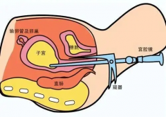 开窗取胚一般不会影响输卵管，还是可以成功怀孕