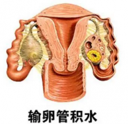 输卵管积水怎么防止复发？专家建议来了