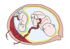 警惕双胎双绒双羊，整个孕期都比较危险