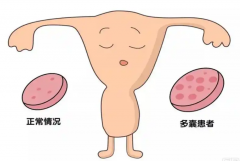 多囊卵巢综合征可以怀孕，助孕方法公开