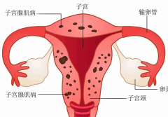 适合子宫腺肌症患者的三种运动，能够帮助改善疾病