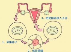 科普人工授精和试管婴儿，两者区别其实很大！