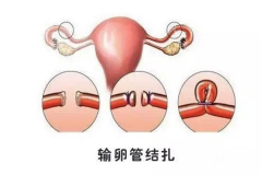 做试管前为什么要先做输卵管结扎手术？哪些人建议做？