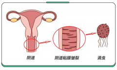 女性一定要警惕阴道炎，教你判断霉菌和滴虫性阴道炎小技巧