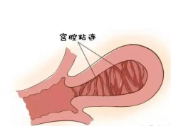 做完宫腔粘连如何防止复发？这些方法能帮助你预防！