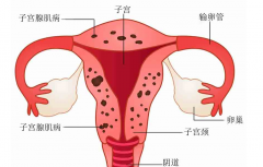 子宫腺肌症一定要先治疗，才能提高试管成功率！