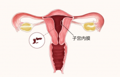 子宫内膜薄应该如何治疗？打促排卵是否真的有效？