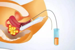 试管婴儿取卵必看：取卵可能引发哪些卵巢问题？