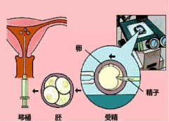 试管婴儿过程中，男性的精子是如何被采集出来的？详细步骤与注意事项