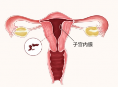 子宫内膜太厚应该怎么治疗？对试管婴儿着床影响大！