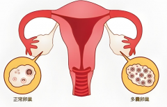 多囊卵巢适合哪种促排卵方案，专家为你科普！